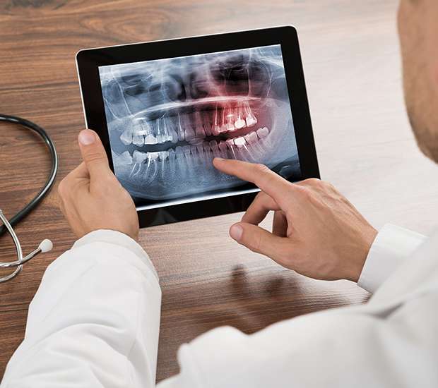 Types of Dental Root Fractures